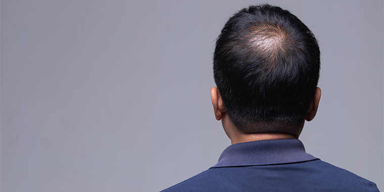 Saiba mais sobre as causas e os tratamentos para alopecia areata.