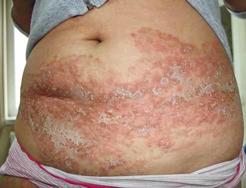 Dermatofitoses: conheça essa infecção fúngica da pele, unhas e cabelos –  ProntoPele