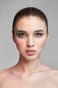 Tratamento da acne